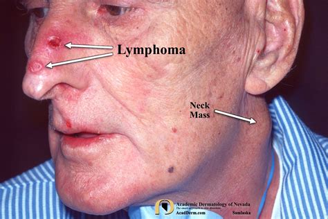 lymphoma images photos pictures|pictures of skin lymphoma stages.